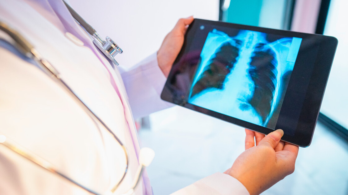 Cáncer de pulmón: revelado el mayor riesgo para los no fumadores Cáncer de pulmón: revelado el mayor riesgo para los no fumadores