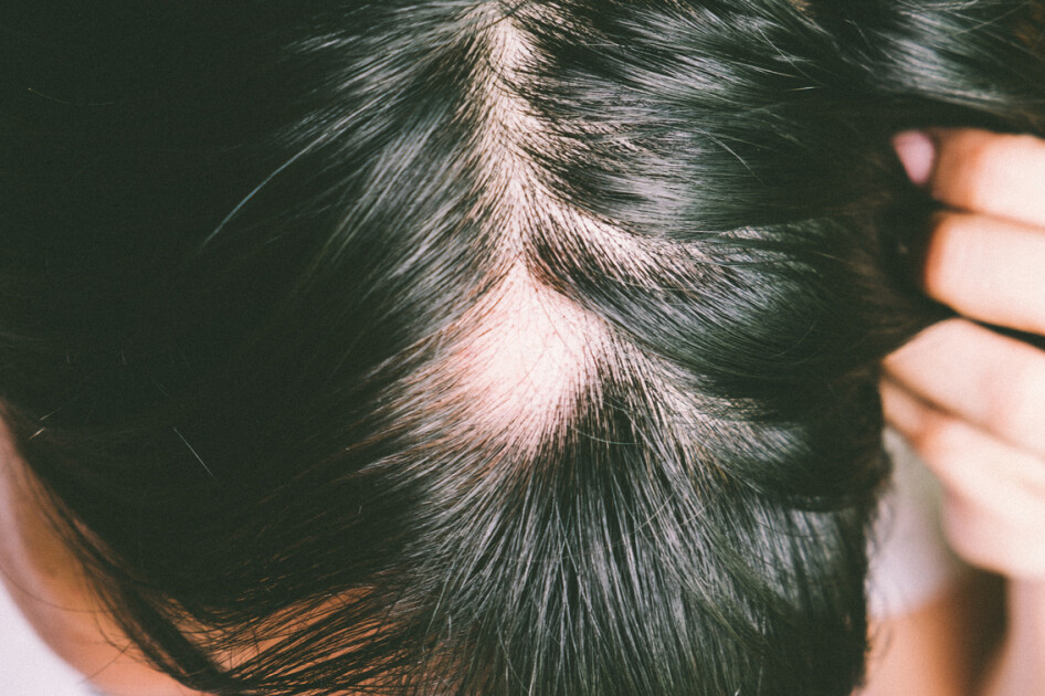 Foltos hajhullás (alopecia areata) tünetei és kezelése | Házipatika