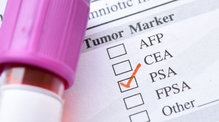 Miért fontos a PSA-szint?