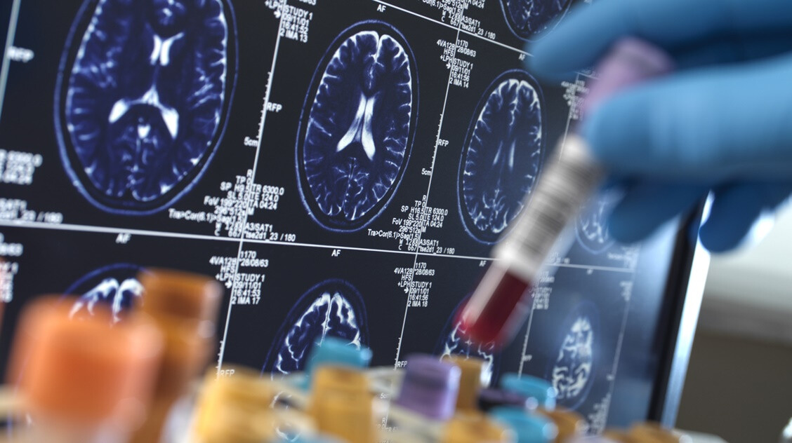 Itt az Alzheimer-kór új formája és az is megvan, mi okozza