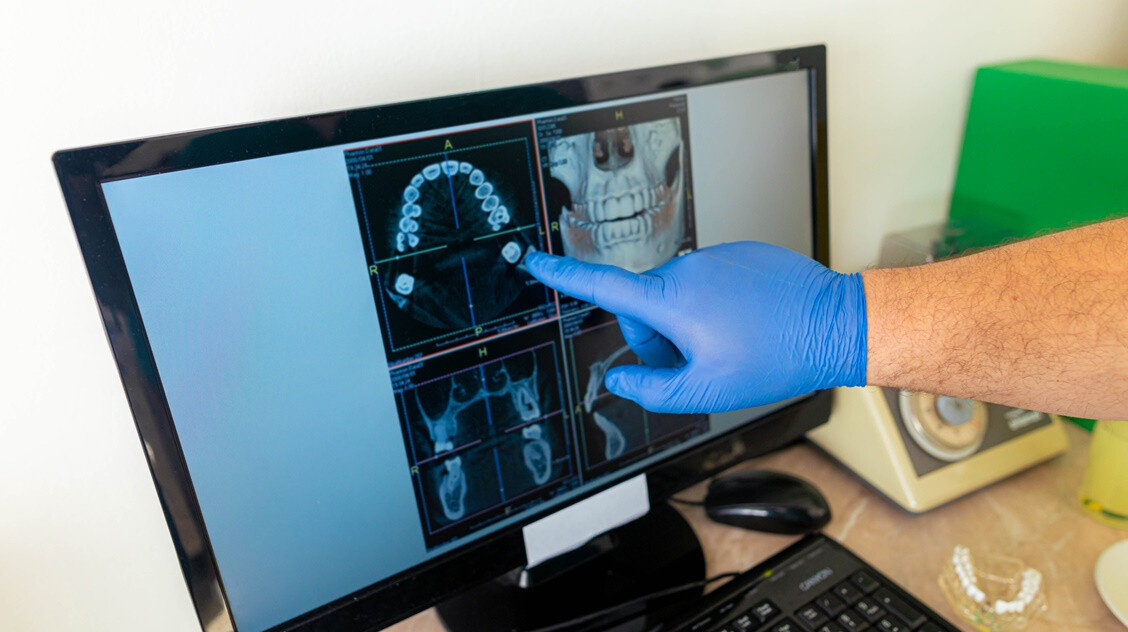 Halogatta a fogorvost, majdnem belehalt a szepszisbe