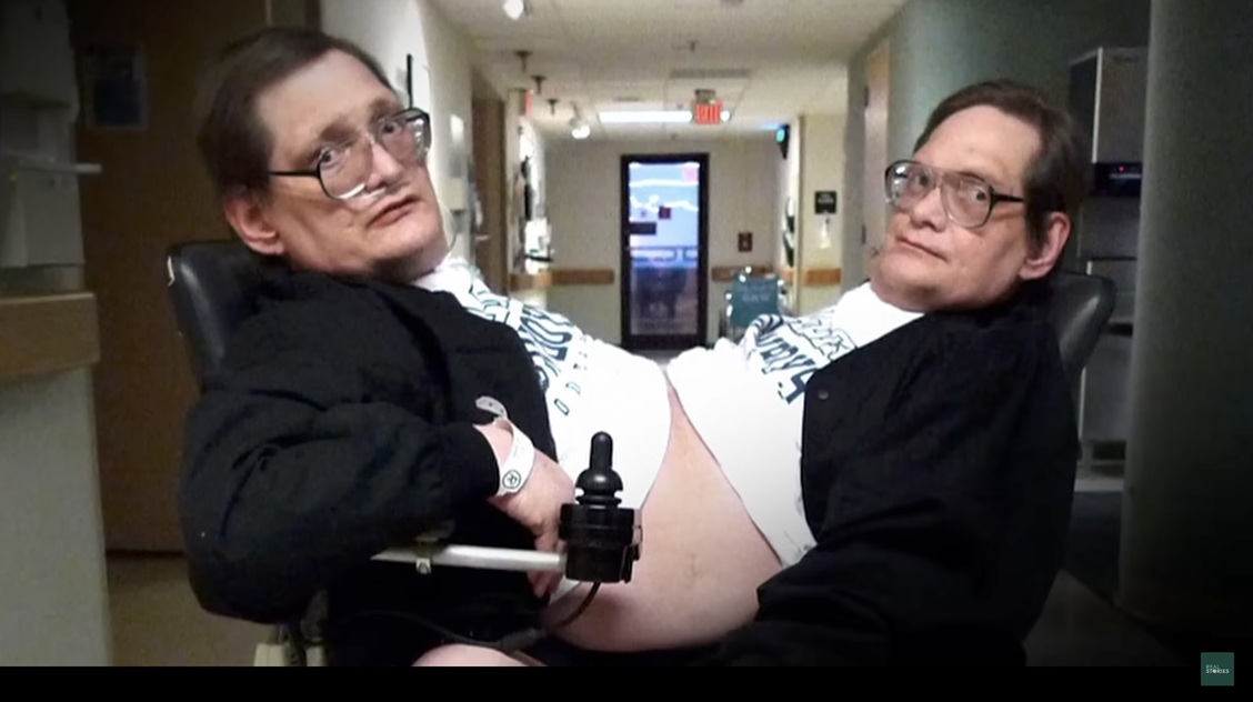 Csak felváltva tudtak aludni – ők voltak a leghosszabb életű sziámi ikerpár